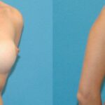 Breast Implant Revision #4 - Before and After