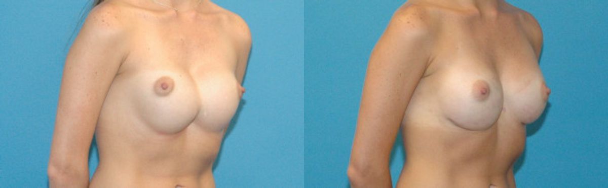 Breast Implant Revision #4 - Before and After