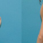 Breast Implant Revision #4 - Before and After