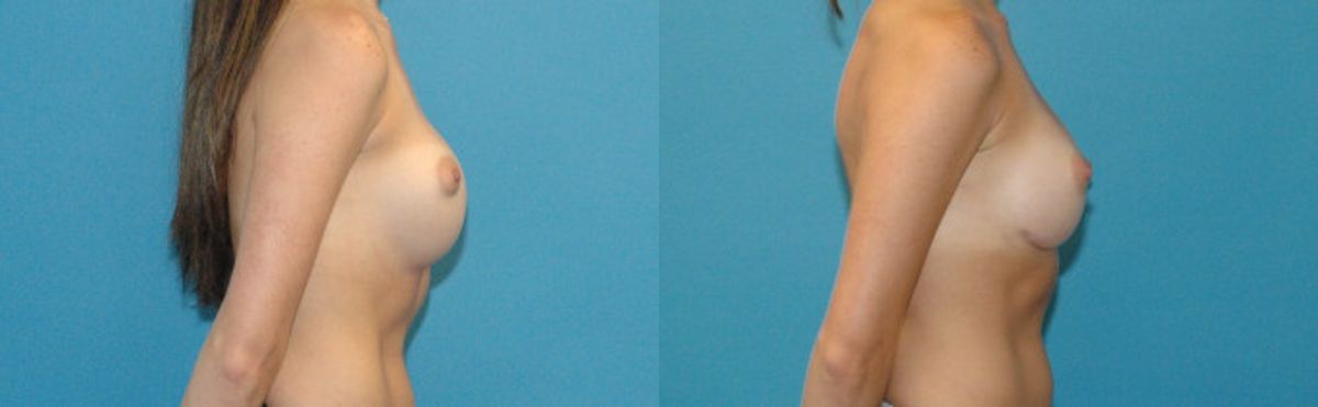 Breast Implant Revision #4 - Before and After