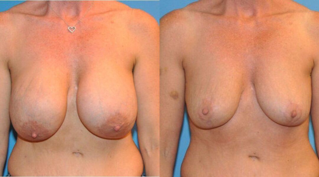 Breast Implant Revision #5