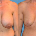 Breast Implant Revision #5 - Before and After