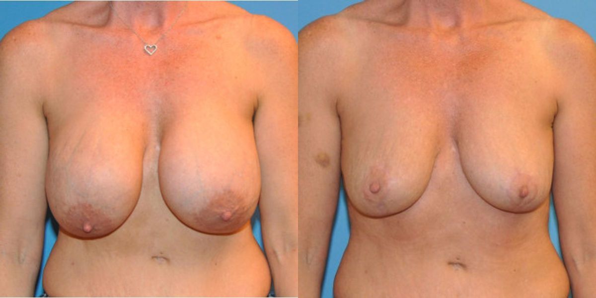Breast Implant Revision #5 - Before and After