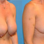 Breast Implant Revision #5 - Before and After