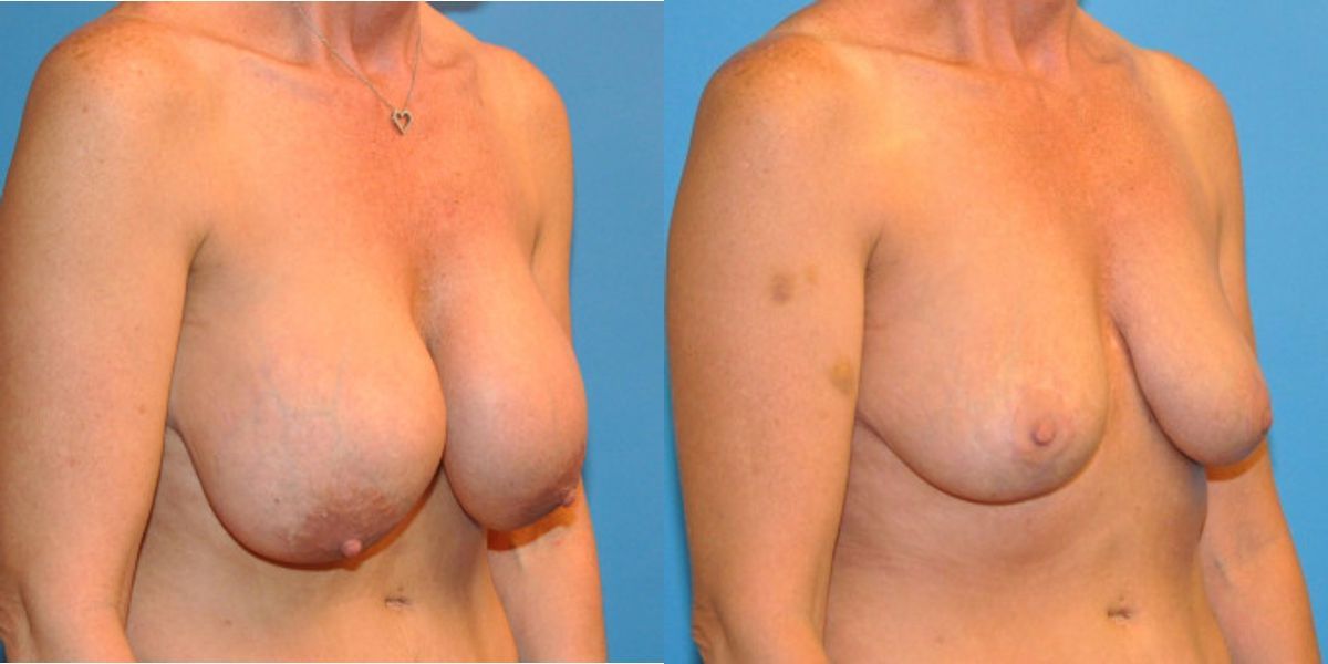 Breast Implant Revision #5 - Before and After
