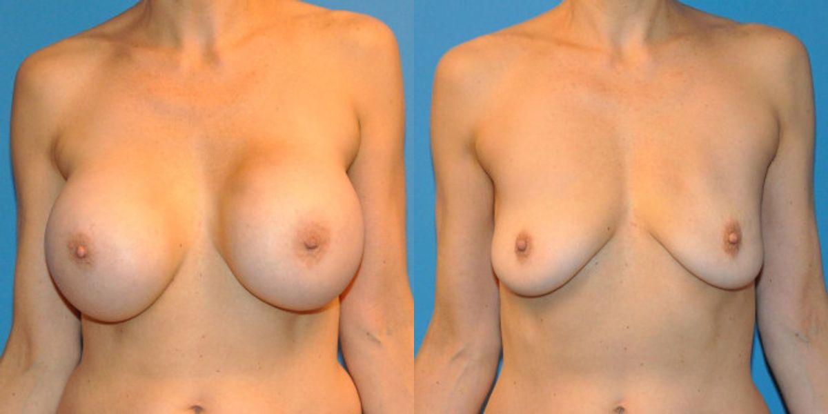 Breast Implant Revision #6 - Before and After