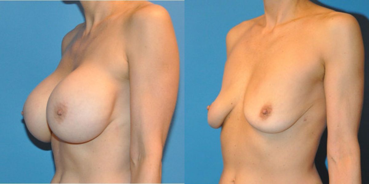 Breast Implant Revision #6 - Before and After