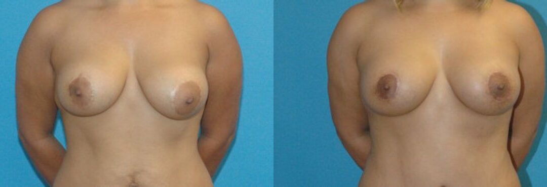 Breast Implant Revision #7