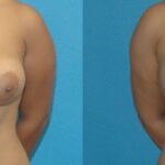 Breast Implant Revision #7 - Before and After