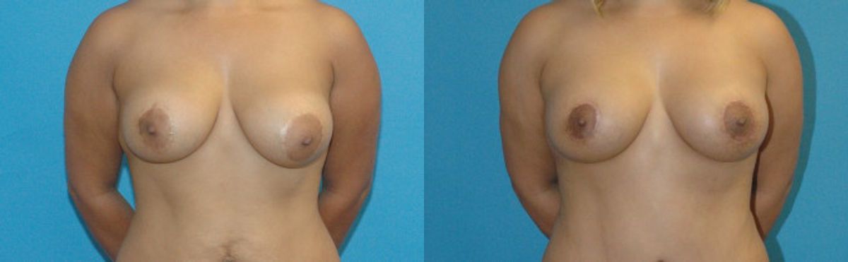 Breast Implant Revision #7 - Before and After