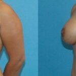 Breast Implant Revision #7 - Before and After
