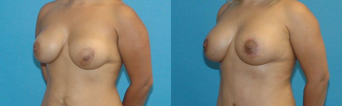 Breast Implant Revision #7 - Before and After