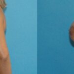 Breast Implant Revision #7 - Before and After