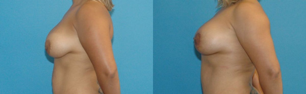 Breast Implant Revision #7 - Before and After