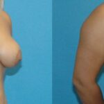 Breast Implant Revision #7 - Before and After