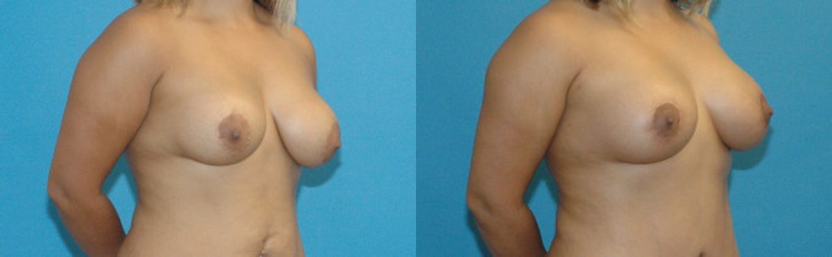 Breast Implant Revision #7 - Before and After