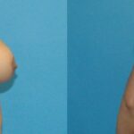 Breast Implant Revision #7 - Before and After