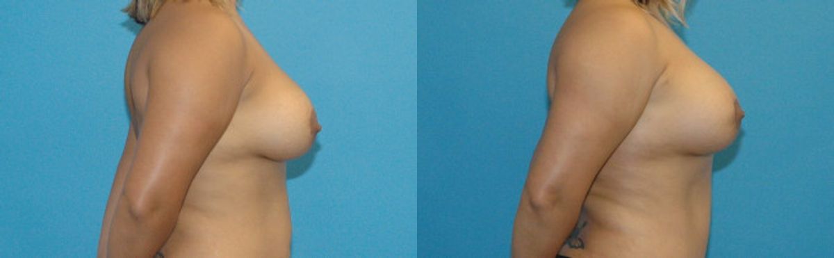 Breast Implant Revision #7 - Before and After