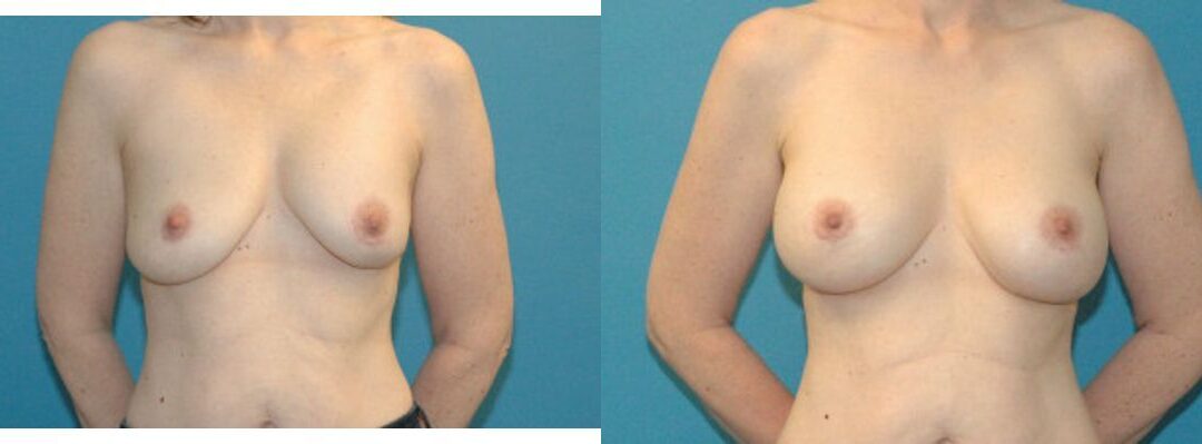Breast Implant Revision #8