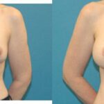 Breast Implant Revision #8 - Before and After