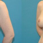 Breast Implant Revision #8 - Before and After