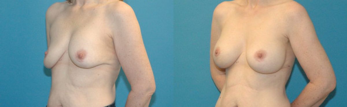 Breast Implant Revision #8 - Before and After