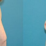 Breast Implant Revision #8 - Before and After