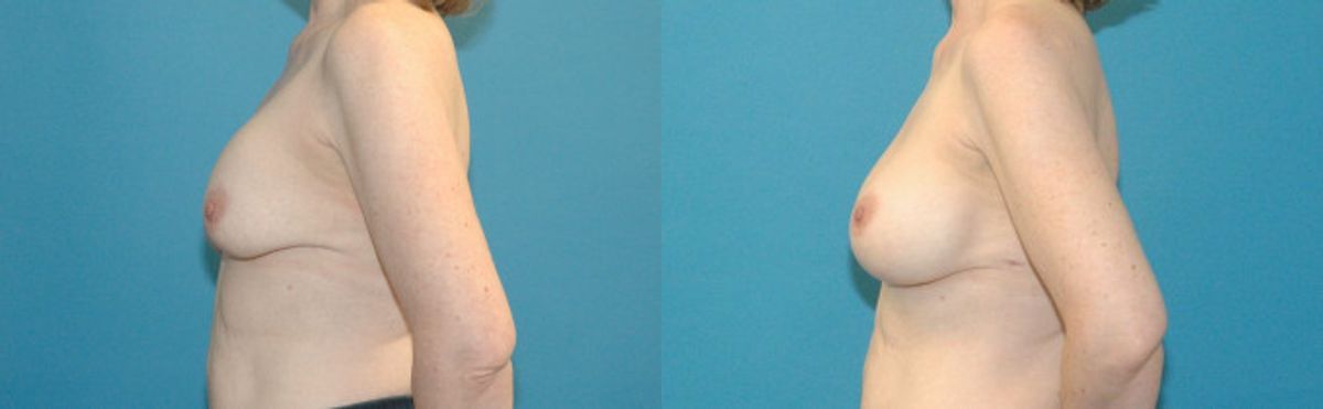 Breast Implant Revision #8 - Before and After