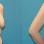 Breast Implant Revision #8 - Before and After