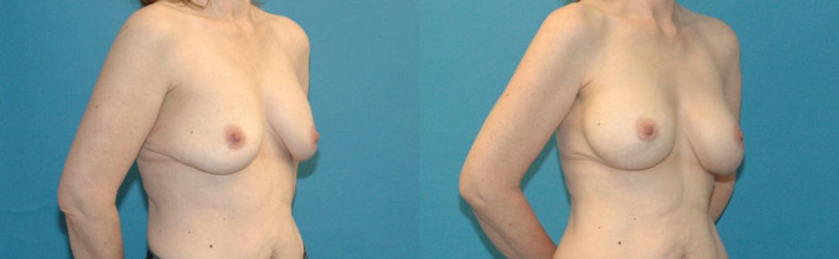 Breast Implant Revision #8 - Before and After