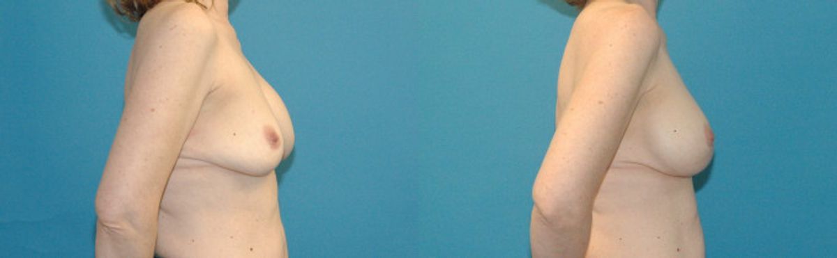 Breast Implant Revision #8 - Before and After