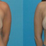 Breast Implant Revision #9 - Before and After