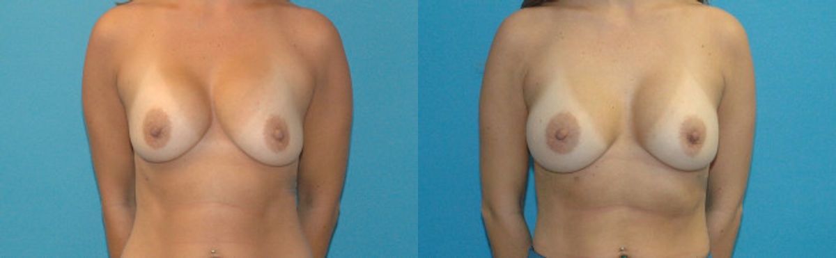 Breast Implant Revision #9 - Before and After