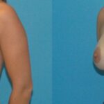 Breast Implant Revision #9 - Before and After