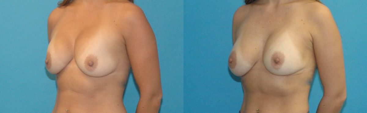 Breast Implant Revision #9 - Before and After