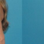 Breast Implant Revision #9 - Before and After