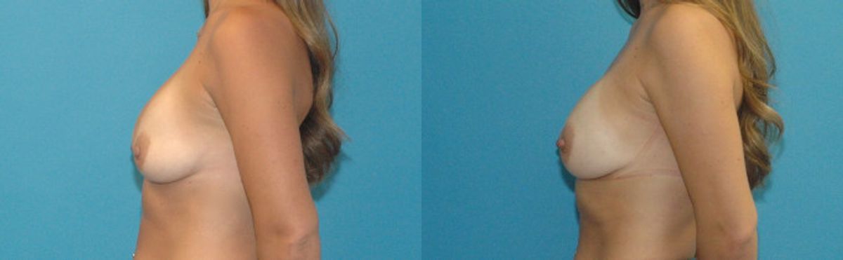 Breast Implant Revision #9 - Before and After