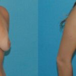 Breast Implant Revision #9 - Before and After