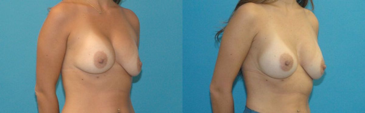 Breast Implant Revision #9 - Before and After