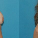 Breast Implant Revision #9 - Before and After
