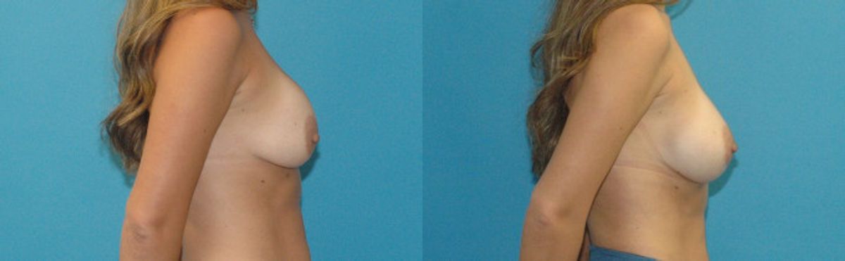 Breast Implant Revision #9 - Before and After