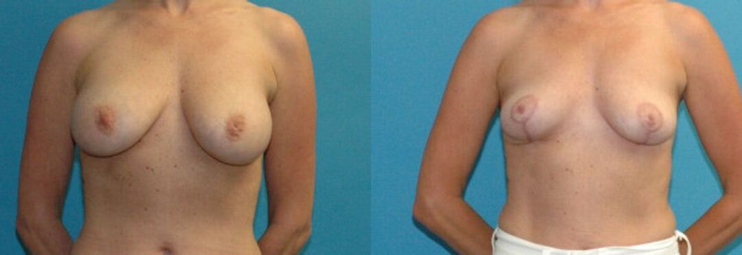 Breast Implant Revision #10