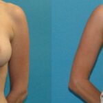 Breast Implant Revision #10 - Before and After