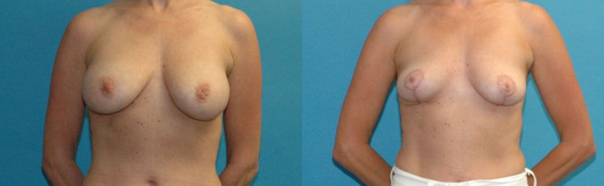 Breast Implant Revision #10 - Before and After