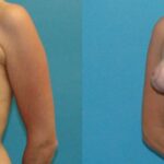Breast Implant Revision #10 - Before and After