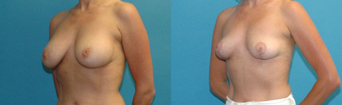 Breast Implant Revision #10 - Before and After