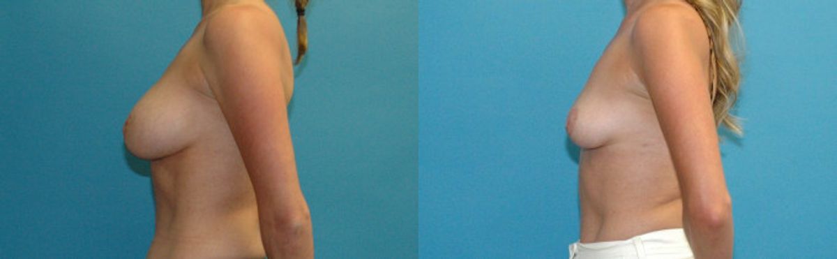 Breast Implant Revision #10 - Before and After