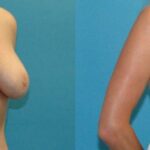 Breast Implant Revision #10 - Before and After