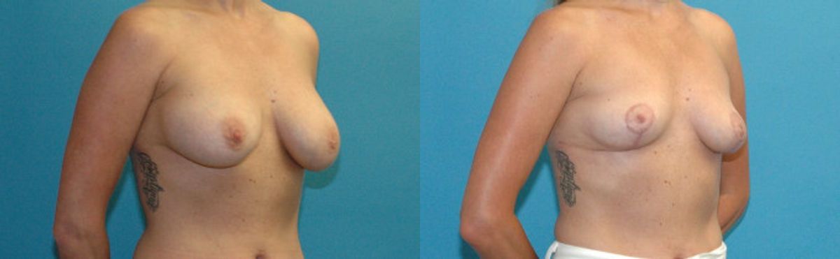 Breast Implant Revision #10 - Before and After
