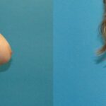 Breast Implant Revision #10 - Before and After